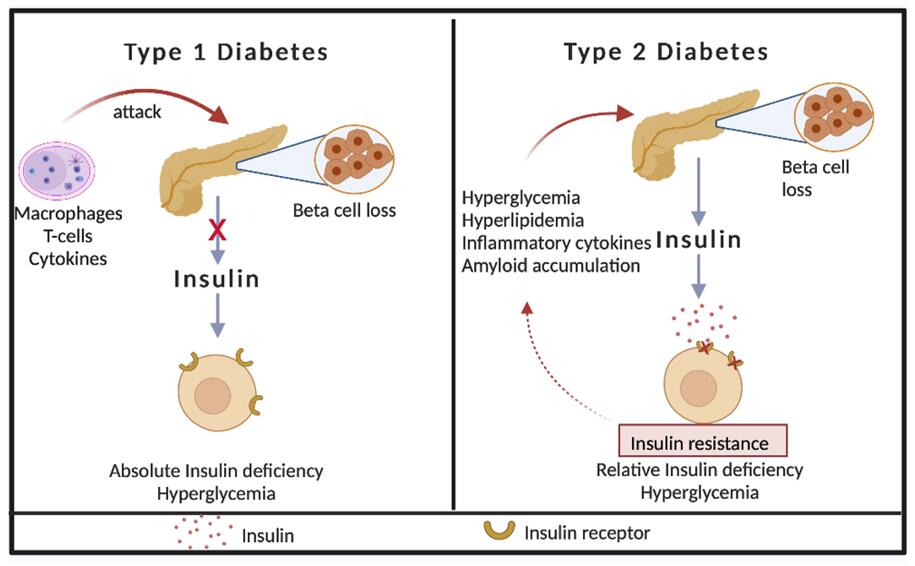 Pathogenesis of type 1 and type 2 diabetes.