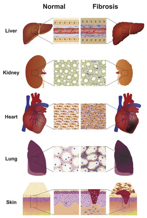 Common characteristics of organ fibrosis. Injurious events lead to organ damage, inflammation, and fibrosis in liver, kidney, lung, heart, and skin.